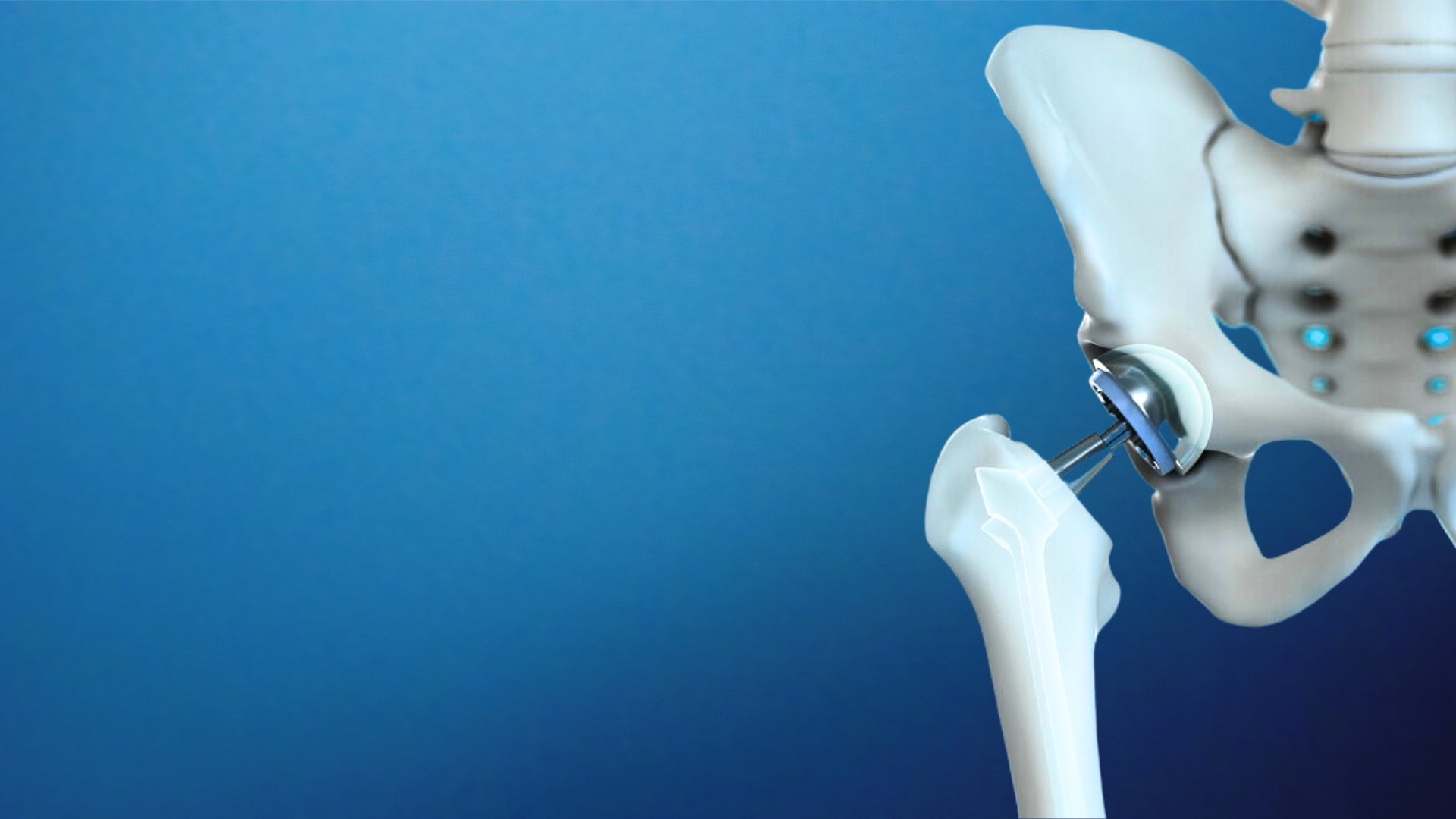 A total hip replacement implant shown seated in the pelvis.