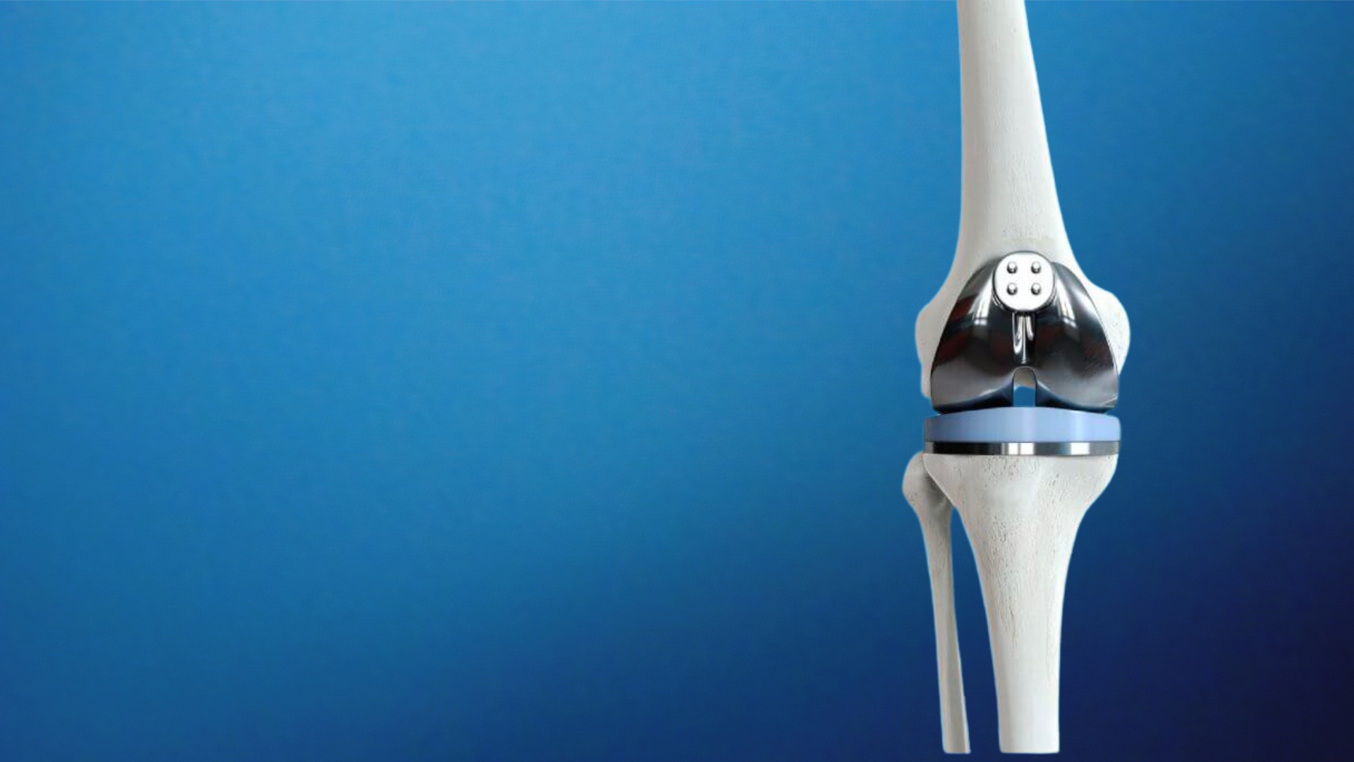 A total knee replacement implant shown in place on the bone.